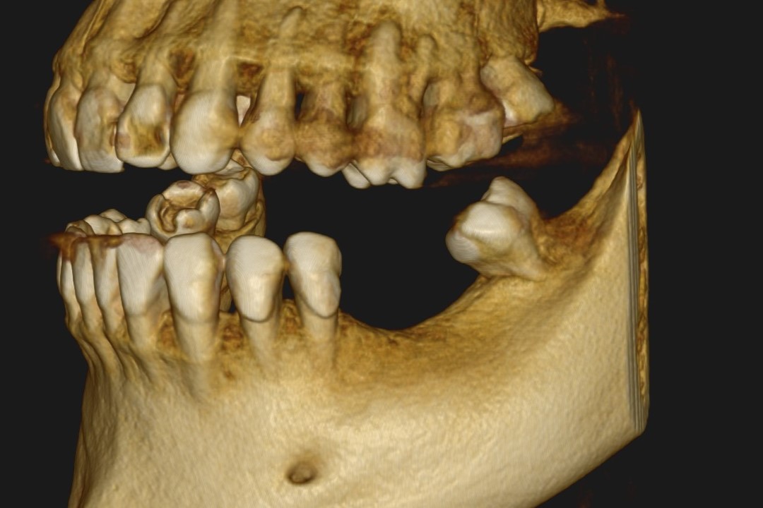Co się stanie, jeśli nie wstawię brakującego zęba?